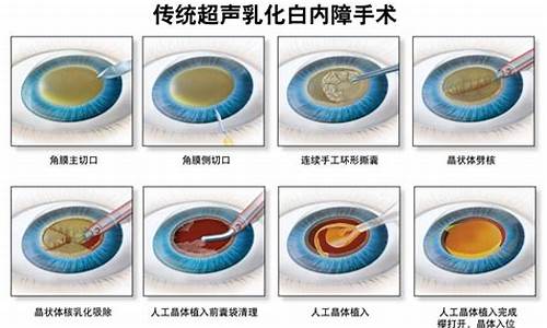 白内障手术什么时候做最好？(图1)